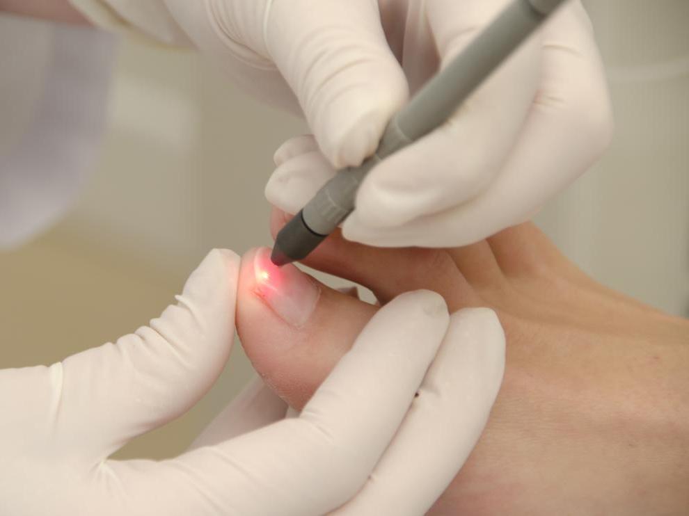 Результативное и быстрое лечение онихомикоза с лазером Alexandrite & Long Pulsed Nd:Yag Laser